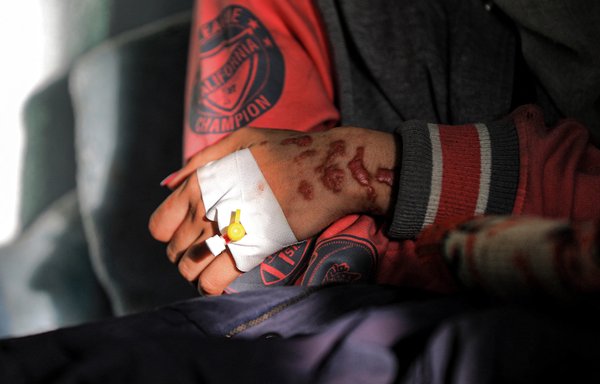 دختر ۱۹ ساله‌ای که شوهر آزارگرش با پاشیدن اسید به صورت او آسیب زده،‌ روز ۹ بهمن ۱۳۹۹ در بیمارستانی در صنعا نشسته است. [محمد حویس/خبرگزاری فرانسه]